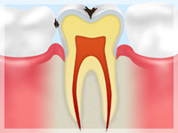 C1：歯の表面のエナメル質が冒された段階です