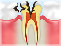 C3：象牙質の内部にある神経まで冒された段階です